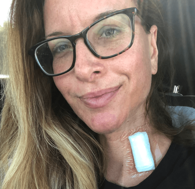PAH patient, Katie, wearing a black shirt and glasses with a white bandage on her neck while sitting in a car